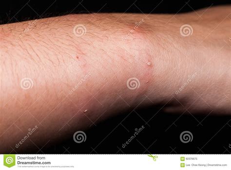 Dog Bite Wound And Scar In Close Up With Dark Background Stock Image