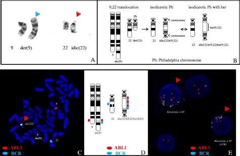Unique Amplification Of Bcr Abl1 Gene Fusion In A Case Of T Cell Acute