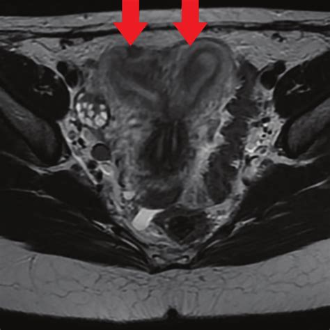 T2 Weighted Axial View Showing Uterus Didelphys Red Arrows