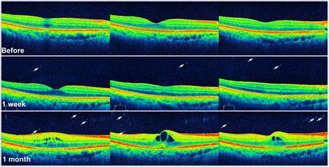 Serial Oct Images Of An Eye With Cystoid Macular Edema At 1 Month After