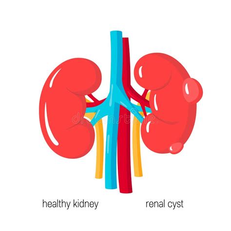Polycystic Kidney Disease Stock Vector Illustration Of Kidney 23250670