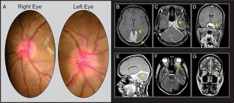 Unilateral Optic Disc Swelling Associated With Idiopathic Hypertrophic