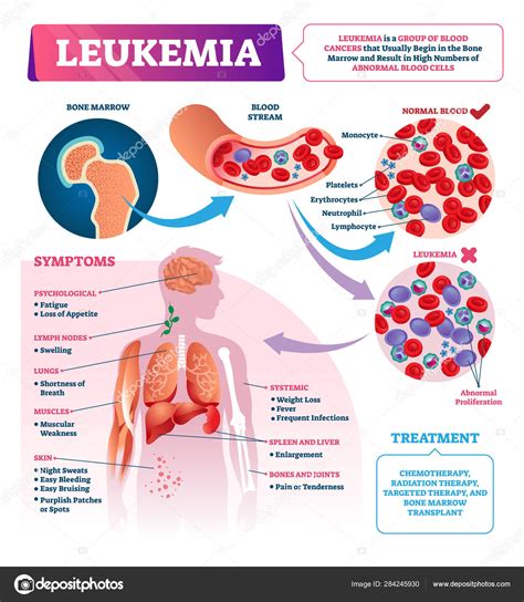 Leukemia Vector Illustration Labeled Educational Blood Cancer