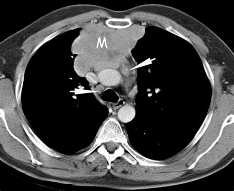 A Contrast Enhanced Ct Shows An Anterior Mediastinal Mass M