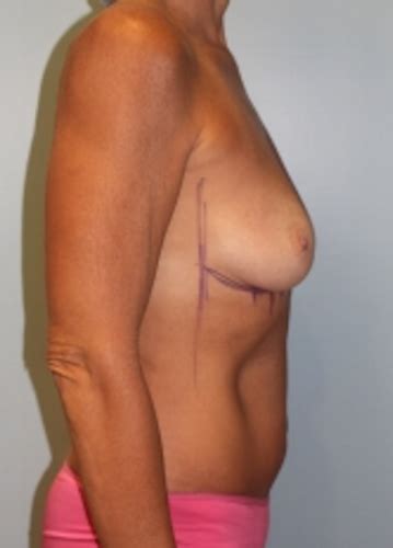 778 Breast Augmentation Before And After Photos Las Vegas Cosmetic