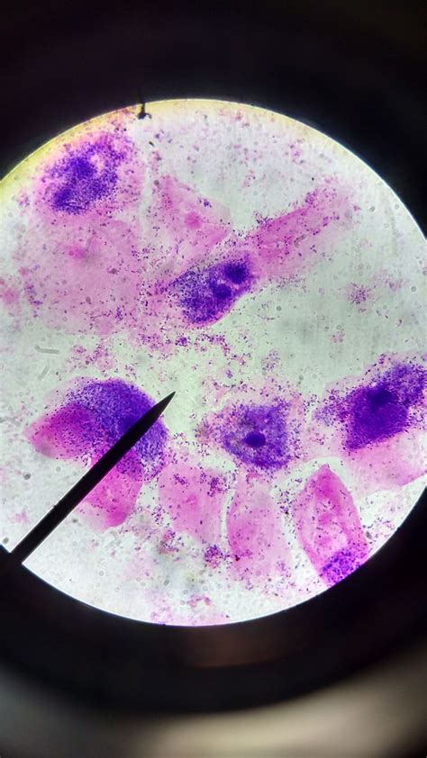 Gardnerella Vaginalis Clue Cells Nugent Score 10 Gram Stains Of