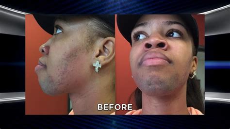 Woman Plagued By Excessive Facial Hair Returns With An Amazing