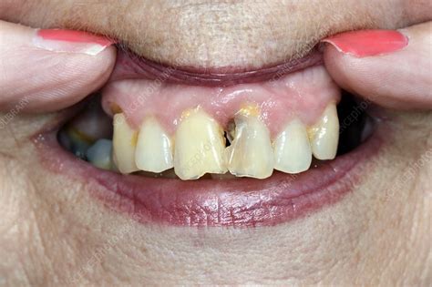 Damaged Teeth From Chemotherapy Stock Image C0151638 Science