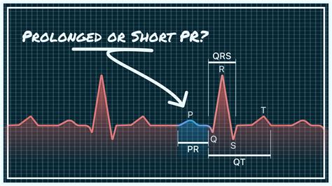 Pr Interval On Your Watch Ecg Short Normal And Prolonged Qaly