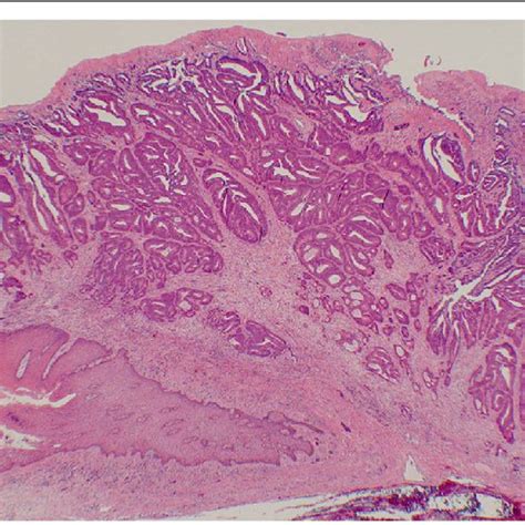 Anal Squamous Cell Carcinoma Synchronous With Rectal Adenocarcinoma