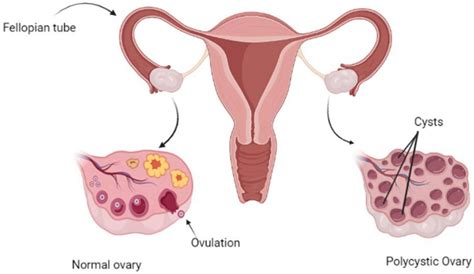 Polycystic Ovary Syndrome Dr Subodh Banzal