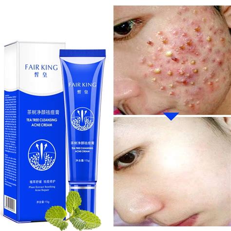 Alextreme Cystic Acne Spot Cream Fast Acting Formula Cream For Clearing