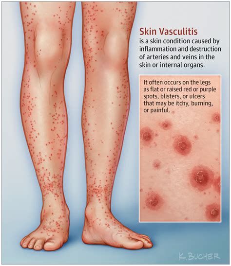 This Patient Page Describes Vasculitis Focusing Especially On Skin Vasculitis How To