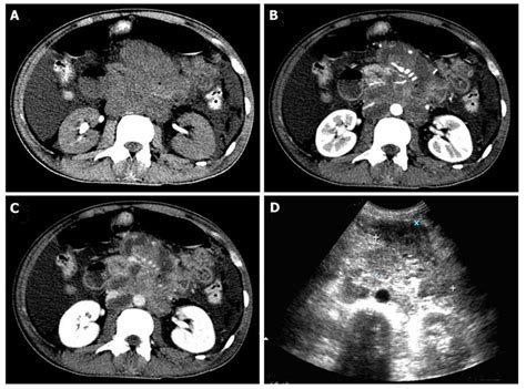 Primary Duodenal Nkt Cell Lymphoma With Massive Bleeding A Case Report