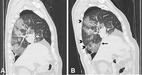Full Text Postoperative Pulmonary Lymphedema After Lobectomy And