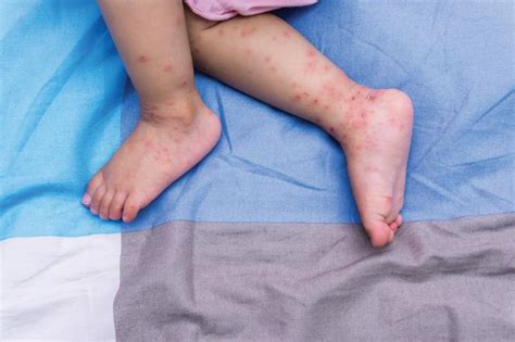 managing hand foot and mouth disease hfmd in primary care latest news for doctors nurses