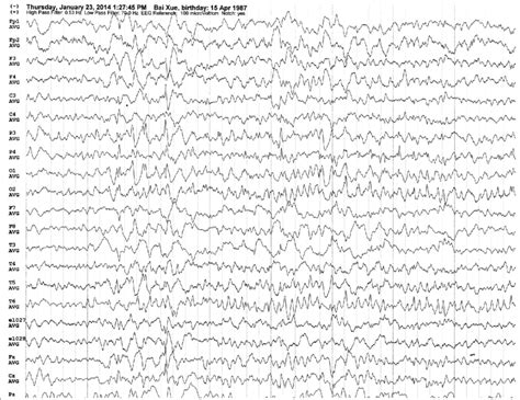 Scalp Eeg Shows Sharp Waves On The Bilateral Occipital Regions And The