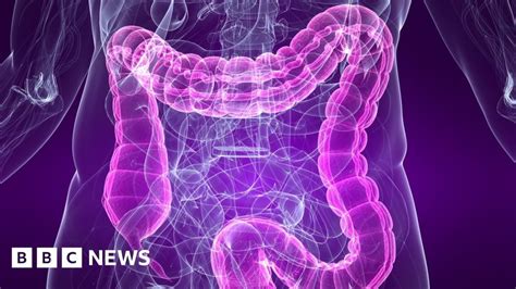 Colon Cancers More Deadly On Right Bbc News