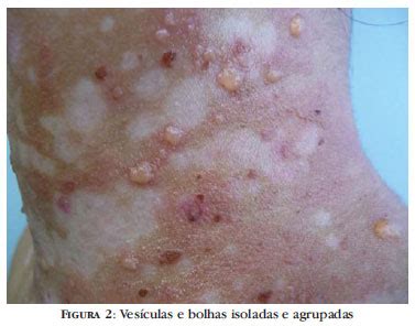SciELO Brasil Lúpus eritematoso sistêmico bolhoso diagnóstico diferencial com dermatite