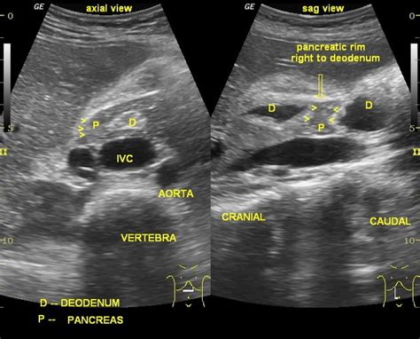 Annular Pancreas Medical Ultrasound Ultrasound Ultrasound Sonography