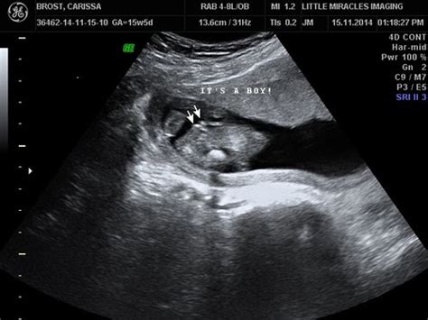 16 Week Ultrasound Told Boy But Could It Be Wrong Babycenter