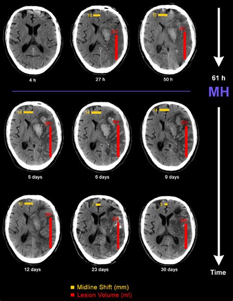 Serial Non Enhanced Brain Ct Scans Showing The Infarction Time Course