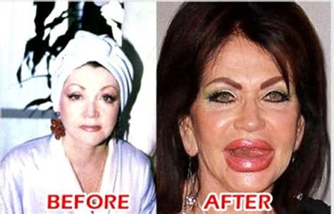 22 Most Shocking Celebrity Before And After Plastic Surgery Shots