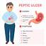Causes And Symptoms Of Peptic Ulcer Stomach Disease Stock Vector 