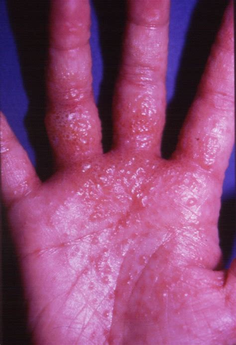 Dyshidrosis Causes Pictures Photos