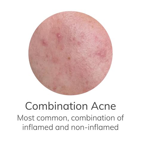 Which Type Of Acne Do I Have Art Of Skin Care