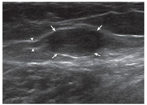 Neurofibroma Ultrasound Image Shows A Well Defined Hypoechoic Mass