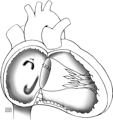 Cone Reconstruction Of The Tricuspid Valve For Ebsteins Anomaly