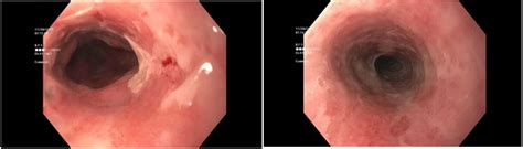 Formulary drug information for this topic. Cytomegalovirus esophagitis in a patient on ocrelizumab ...