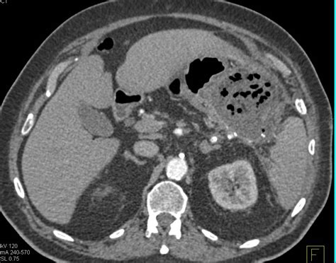 Pancreatic Abscess Extends To The Stomach Pancreas Case Studies