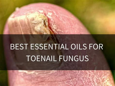5 Best Essential Oils For Toenail Fungus Toe Fungus Journey That Work
