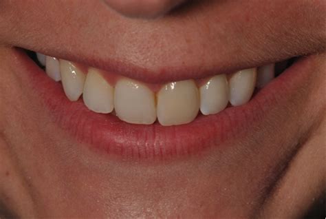 Correction Of A Single Discolored Anterior Tooth Due To Internal