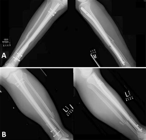 A And 2 B Radiographs Showing Fractures Without And With Cortical