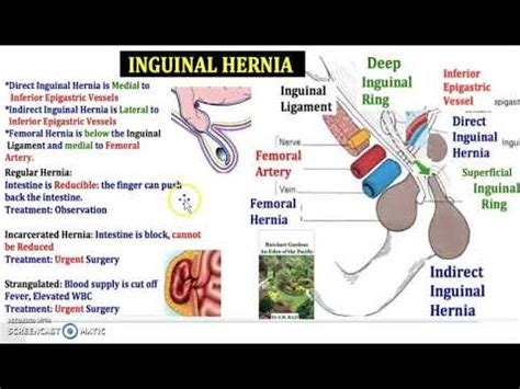 It is five times more common than a direct inguinal hernia, and is seven times more frequent in males, due to the persistence of the processus vaginalis during testicular descent. Hernia: Types Inguinal Hernia Groin Direct Indirect ...