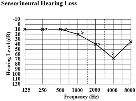 Classification Of Hearing Loss Intechopen