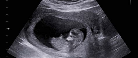 12 week ultrasound