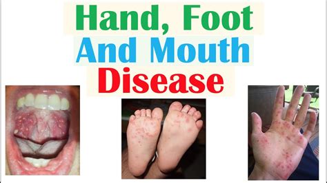 Hand Foot And Mouth Disease Viruses Pathophysiology Signs And
