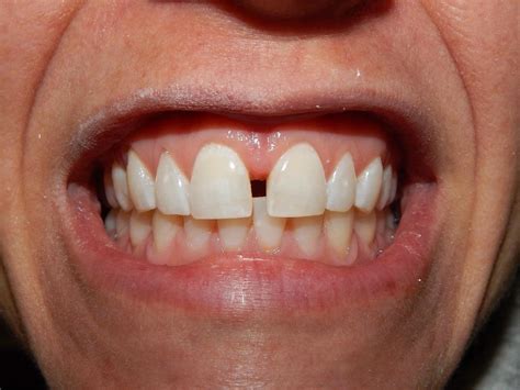 Cosmetic Dentist Aston Pa Results From Dental Bonding