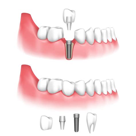 Dental Implant Vs Crown Dr Ben Lee