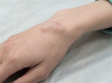 What Are These Bumps On My Hands And Wrists By Dr Vanessa Cuéllar
