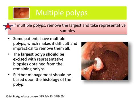 Management Of Gastric Polyps