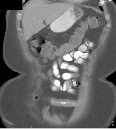 Crohns Disease Of The Terminal Ileum With Strictures Small Bowel