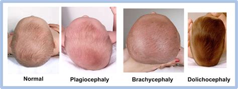 Plagiocephaly, also known as flat head syndrome, is a condition characterized by an asymmetrical distortion (flattening of one side) of the skull. Specially Designed Baby Pillow for Plagiocephaly and ...