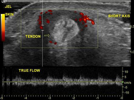 Extensor Carpi Ulnaris Tendinosis And Tenosynovitis Radiology Case