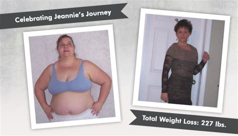 Before After Rny Gastric Bypass With Jeannie Losing Lbs