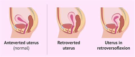 Different Posititions Of The Uterus